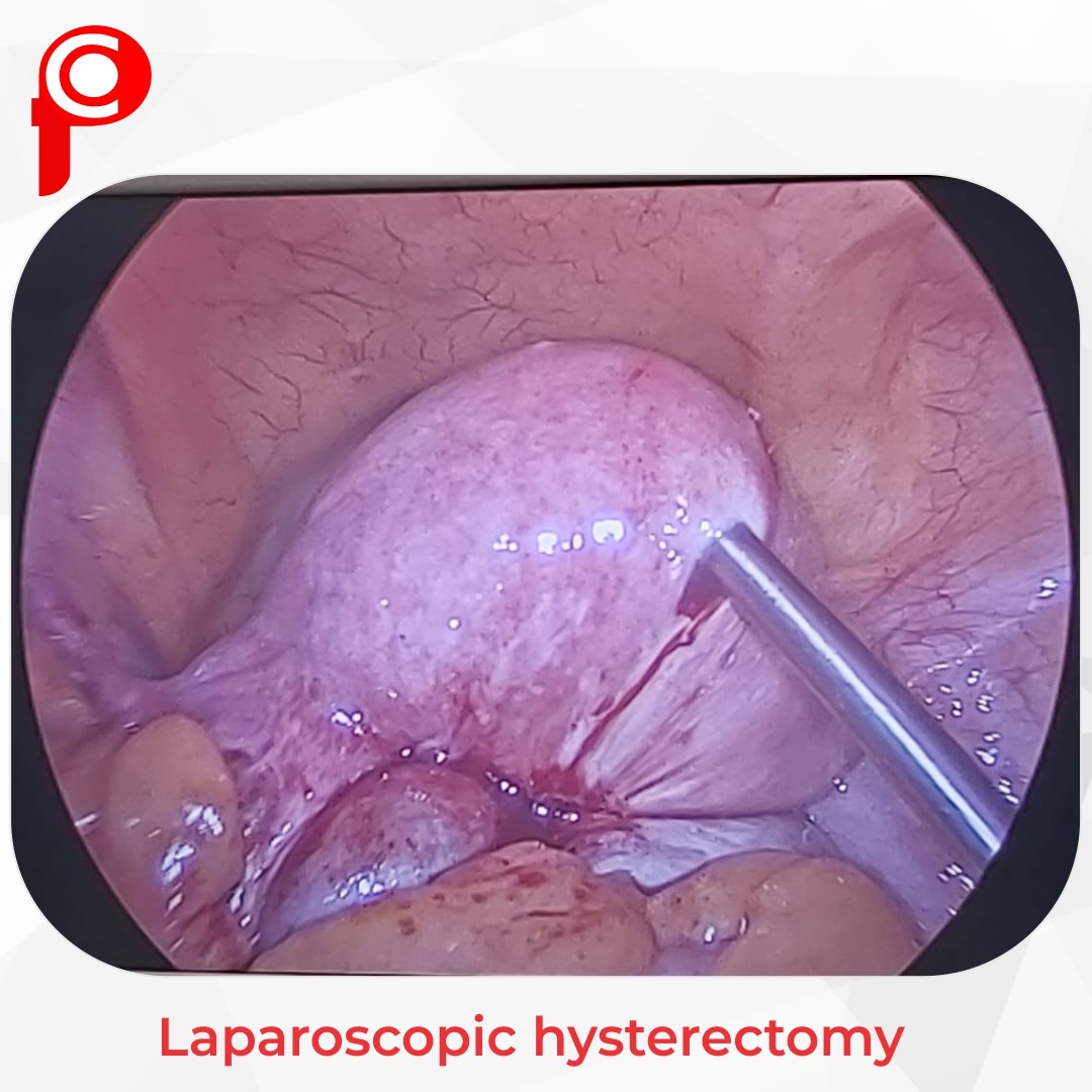 laparoscopic hysterectomy in indore, laparoscopic surgeon indore, laparoscopic surgery in indore