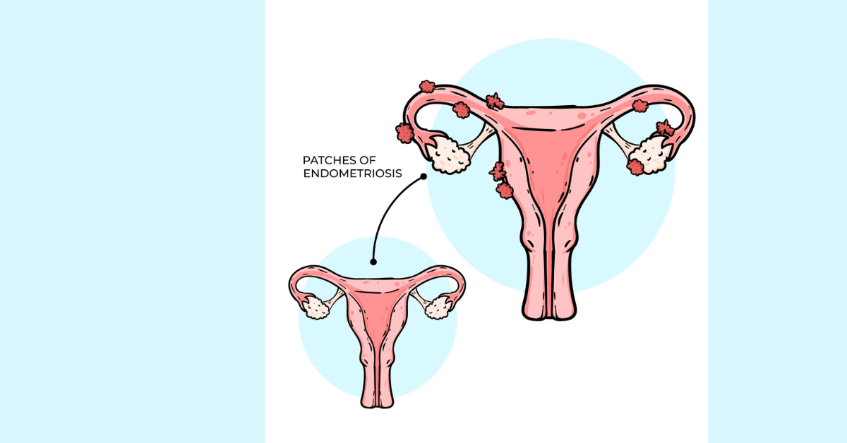 laparoscopic gynecological surgery in indore